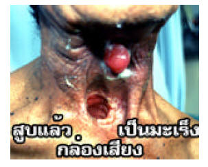 Thailand 2006 Health Effects other - lived experience, throat cancer, gross